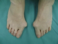 Ayak Baş Parmak Çıkması Belirtileri ve Tedavisi