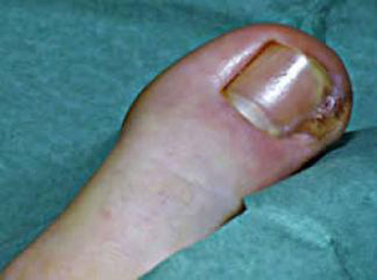 Ayak Baş Parmak İltihabı Belirtileri ve Tedavisi