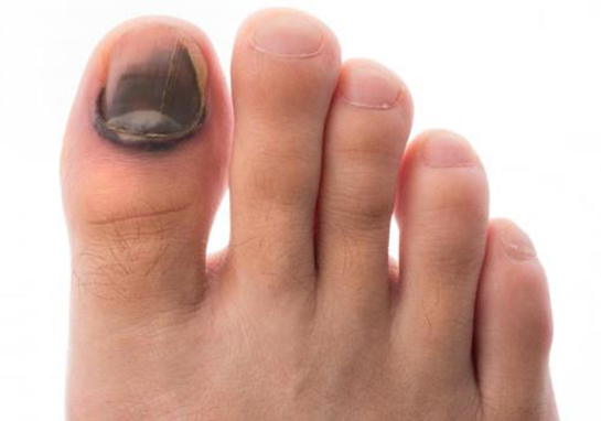 Ayak Baş Parmak Morarması Belirtileri ve Tedavisi